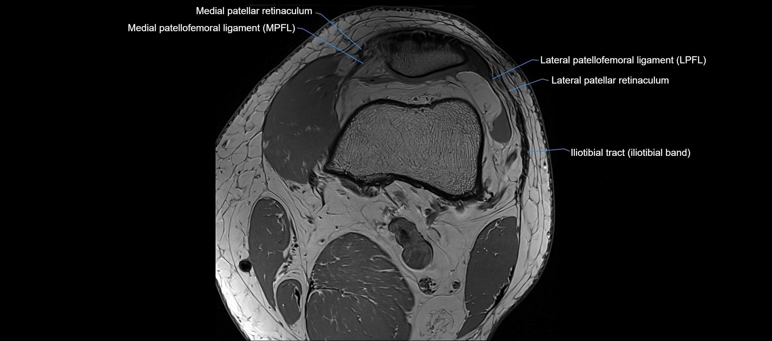 MRI Knee axial  ligaments cross sectional anatomy 3T  radiology  image-img-03001-00009.webp
